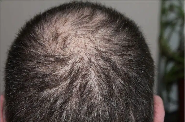 5 Things To Know On Avoiding Hair Loss