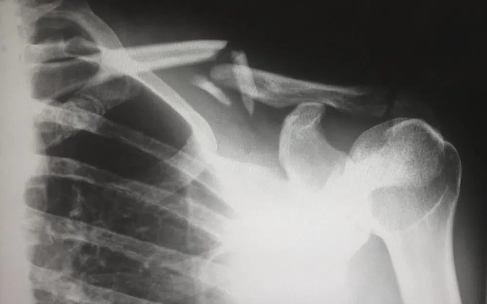 5 Common Sports-Related Injuries