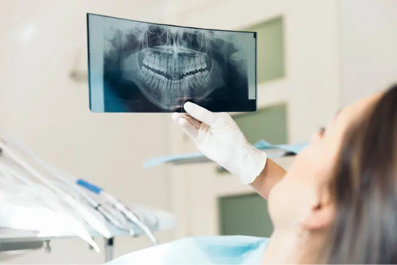 What Is Full Mouth Rehabilitation