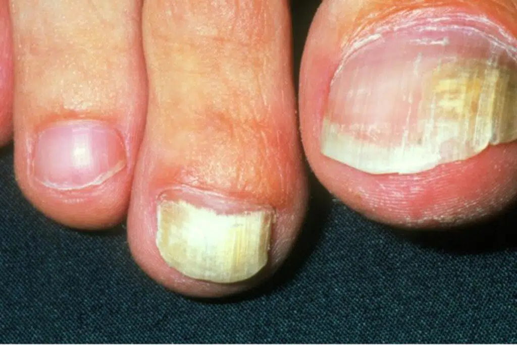 What Is The Best Treatment For Onychomycosis - Find Out