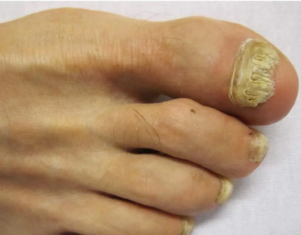 What Is The Best Treatment For Onychomycosis - Find Out