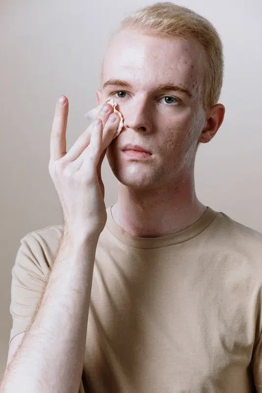 What's It Like To Live with A Skin Condition?