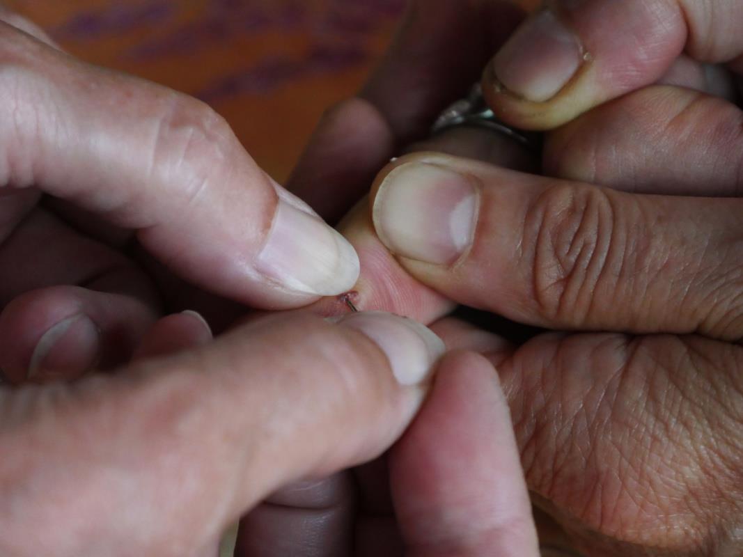 How Do You Remove A Deep Embedded Splinter?