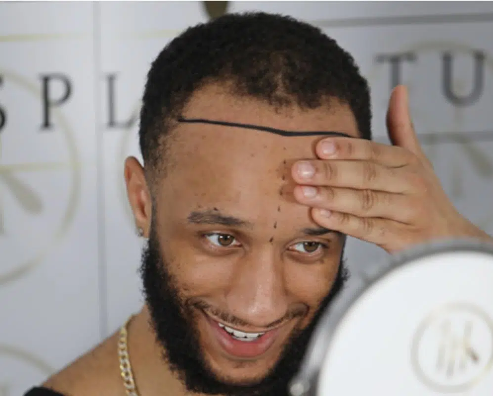 Hair Transplant Price In Turkey