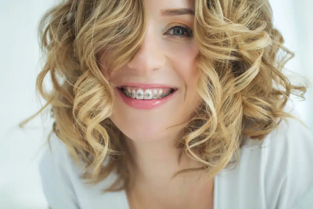 3 Ways You Can Make Your Braces Less Noticeable