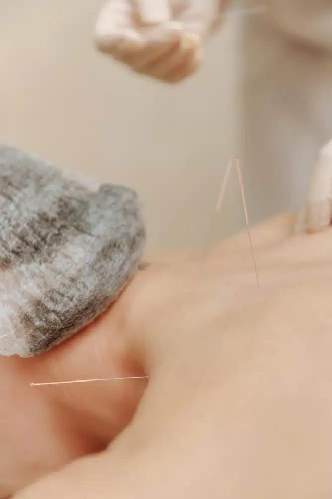 How Acupuncture Can Help You Relieve Pain