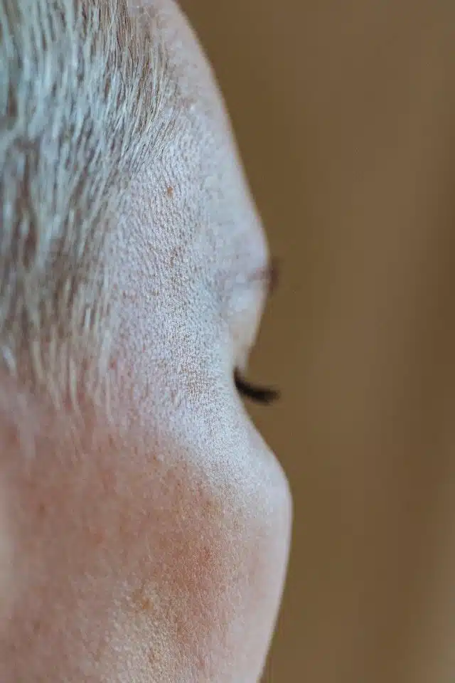 Causes And Treatment Of Melasma To Urge Eliminate Facial Spots