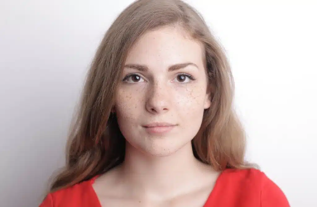 Causes And Treatment Of Melasma To Urge Eliminate Facial Spots