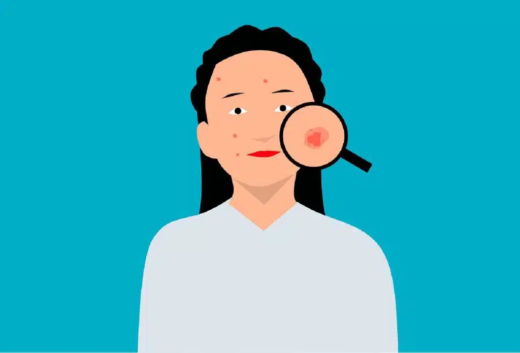 A Good Explanation On Why People Get Different Acne Treatments