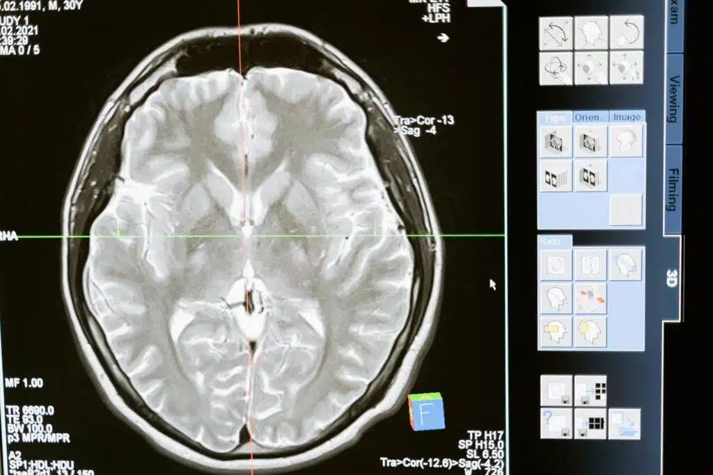 How To Manage Memory Problems After A Brain Injury
