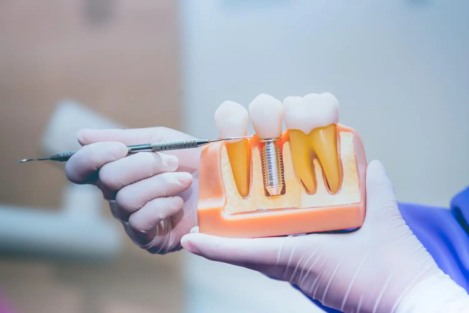 Your Path To A Confident Smile: The Process Of Getting Dental Implants In Mississauga