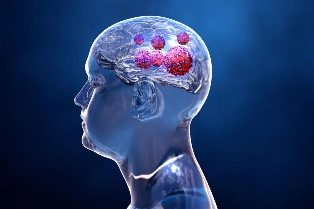 The 4 Types of Brain Injuries You Should Know About