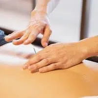 Crop anonymous male doctor putting needles on back during acupuncture therapy session in rehabilitation salon